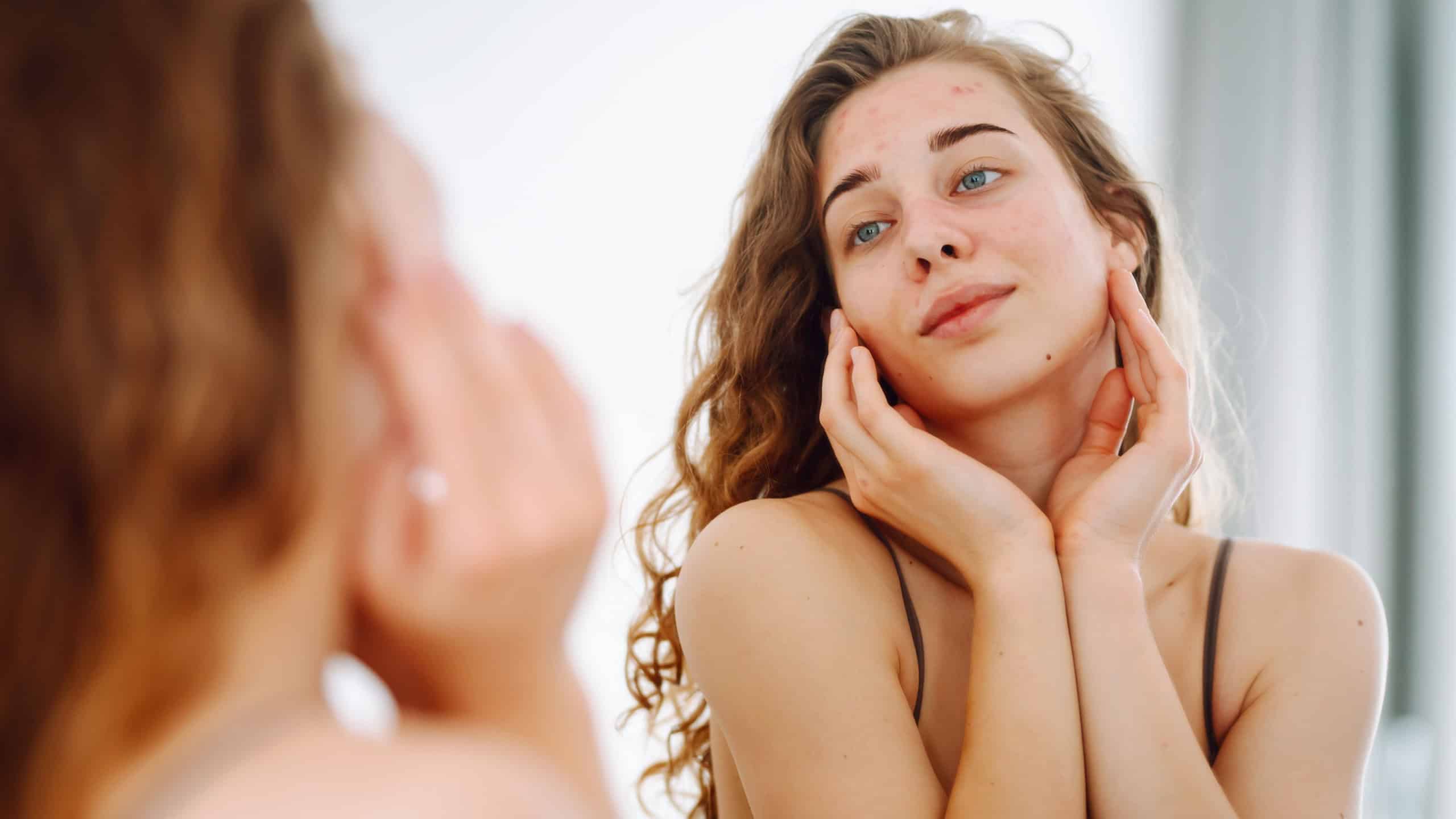 Beautiful young woman with problematic skin. Acne problem concept