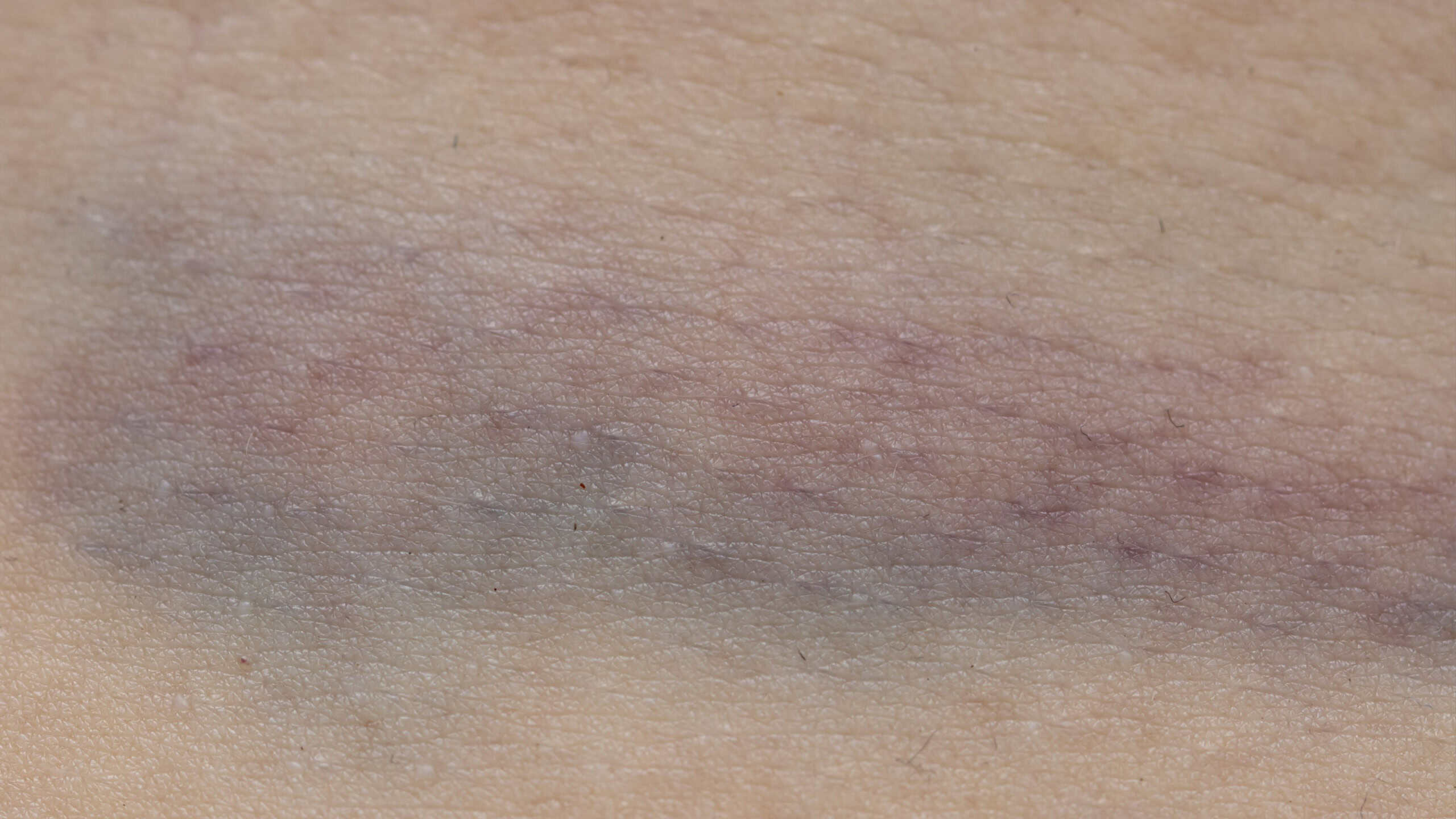 A person's arm with a bruise. The bruise is purple and black. The skin is pink