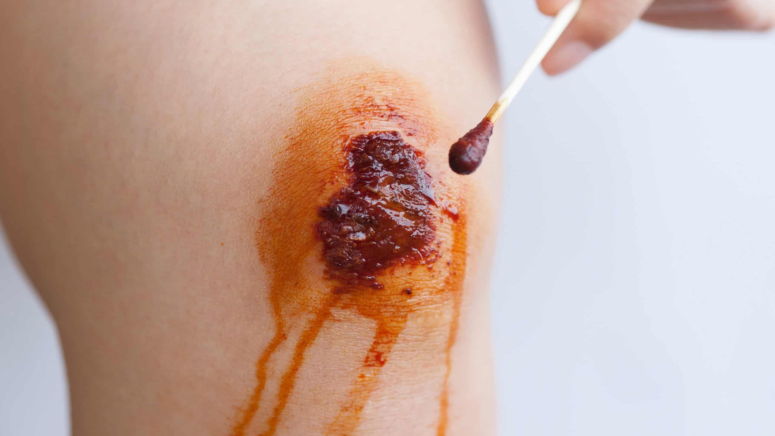 Disinfecting cotton swab with Iodophor on bike injured knee